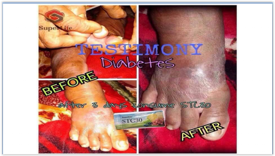 Diabetes testimony. Out of 15 sachets of stc30 in one box, she used only 3 sachets and look at what happened to her in the space of 3 days🤗🤗👆👆👆