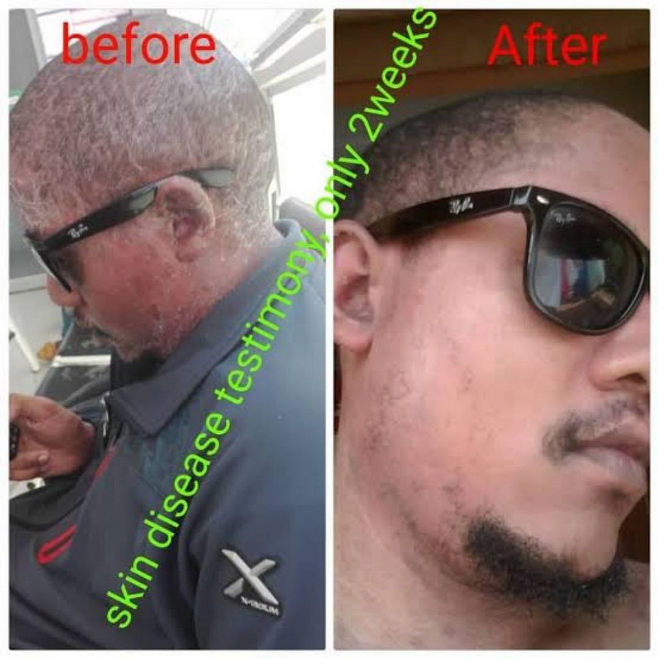 He used only 1 box of Stc30(15 sachets), look at what happened to his skin in a space of 2 weeks👍👍👍👆👆👆👆