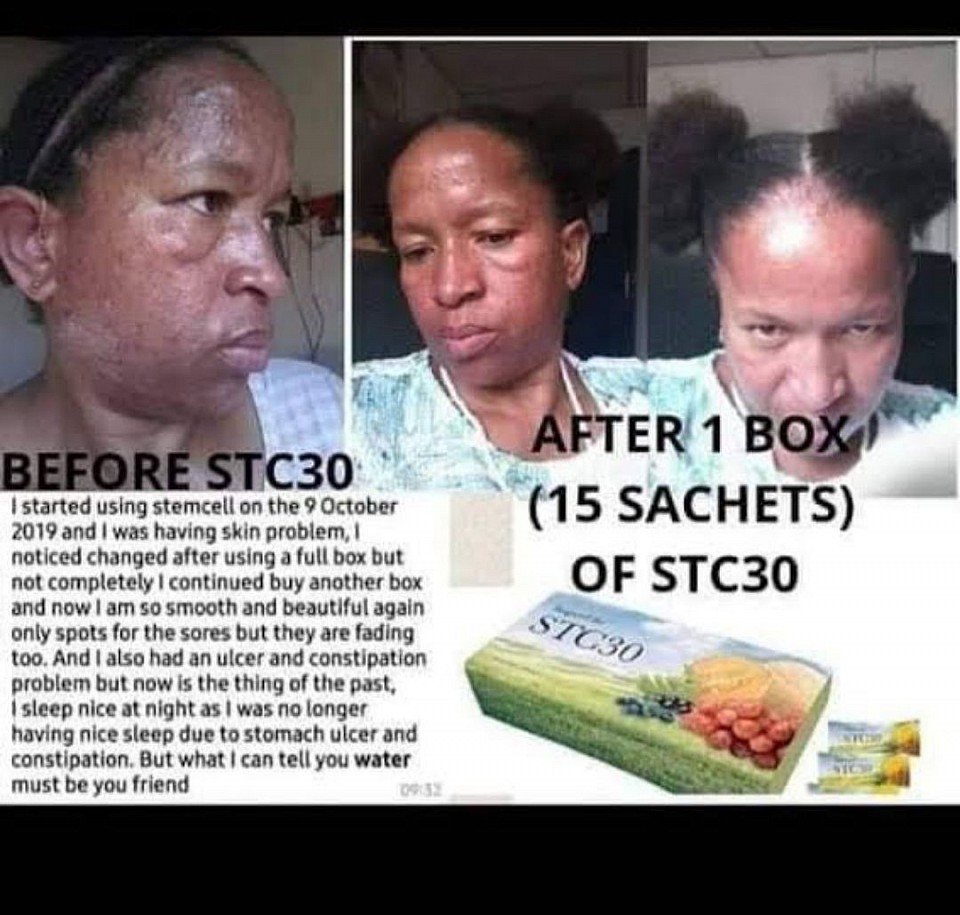Skin problem solved in 15 days because of Stc30👆👆👆🤭
